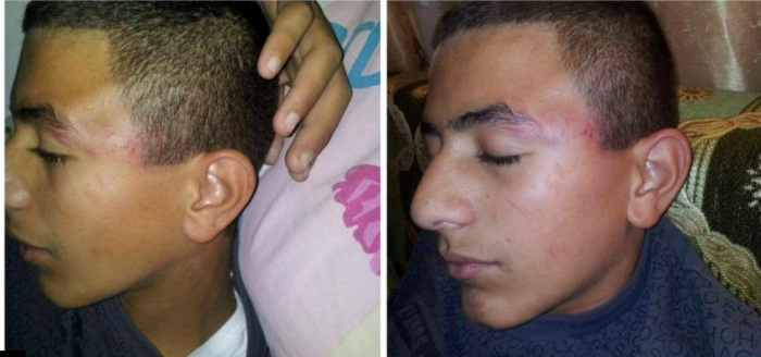 الجنود الصهاينة  يعتدون على طالب مدرسة برأس العامود